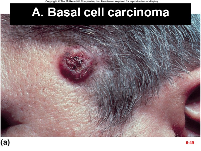 Fig. 6.12a A. Basal cell carcinoma 6-49